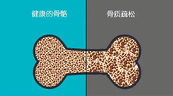 心理健康也會影響骨骼健康導致骨質流失？.jpg