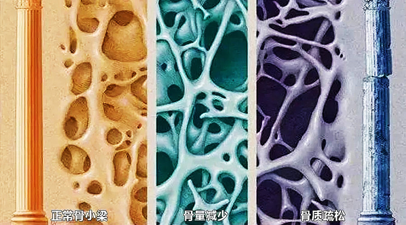 骨質疏松.jpg